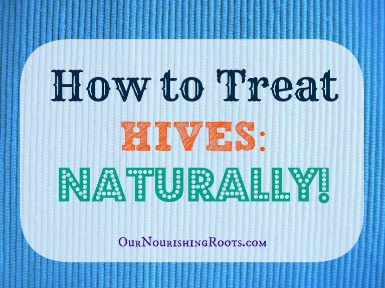 How to Naturally Treat Hives